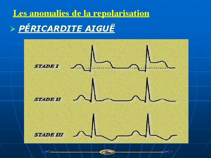 Les anomalies de la repolarisation Ø PÉRICARDITE AIGUË 