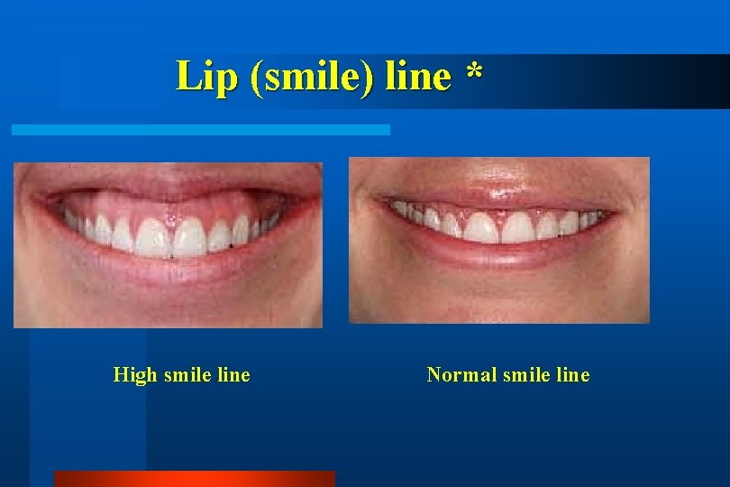 Lip (smile) line * High smile line Normal smile line 