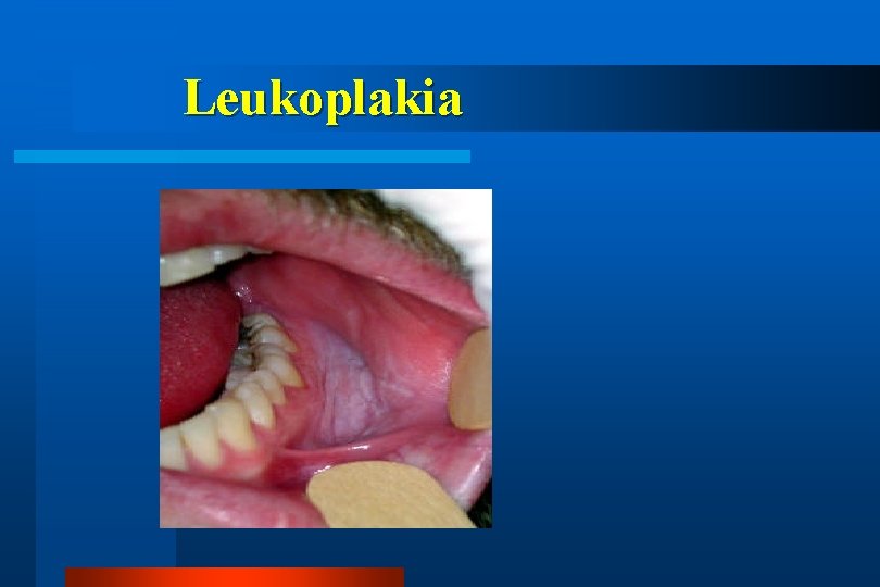 Leukoplakia 