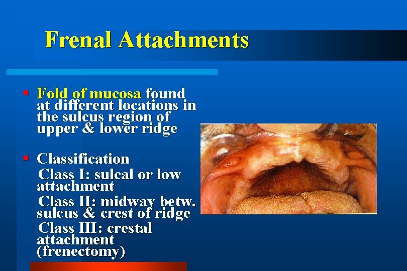 Frenal Attachments Fold of mucosa found at different locations in the sulcus region of