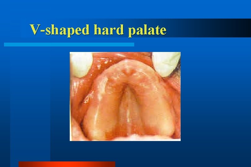 V-shaped hard palate 