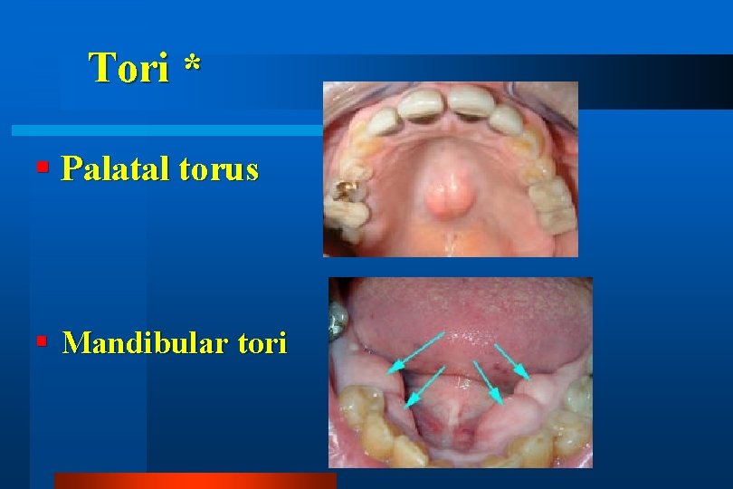 Tori * Palatal torus Mandibular tori 