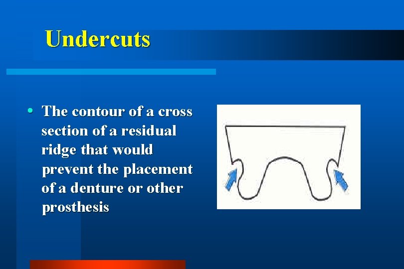 Undercuts The contour of a cross section of a residual ridge that would prevent