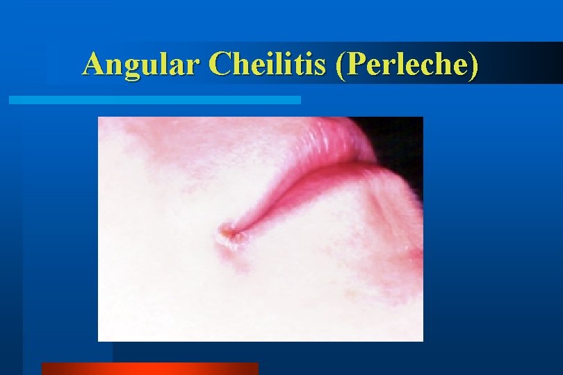 Angular Cheilitis (Perleche) 