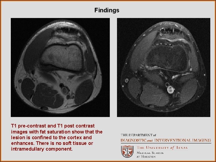 Findings T 1 pre-contrast and T 1 post contrast images with fat saturation show