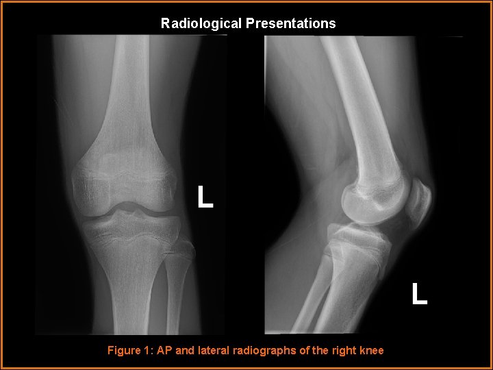 Radiological Presentations Figure 1: AP and lateral radiographs of the right knee 