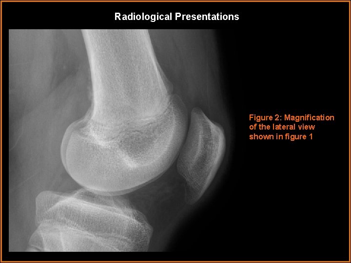 Radiological Presentations Figure 2: Magnification of the lateral view shown in figure 1 