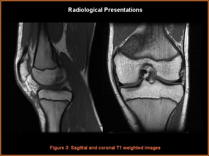 Radiological Presentations Figure 3: Sagittal and coronal T 1 weighted images 