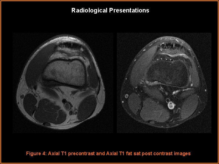 Radiological Presentations Figure 4: Axial T 1 precontrast and Axial T 1 fat sat