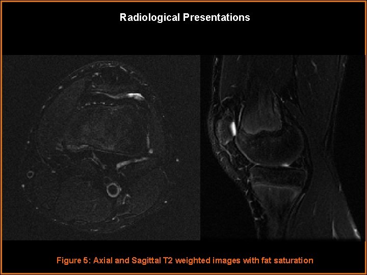 Radiological Presentations Figure 5: Axial and Sagittal T 2 weighted images with fat saturation