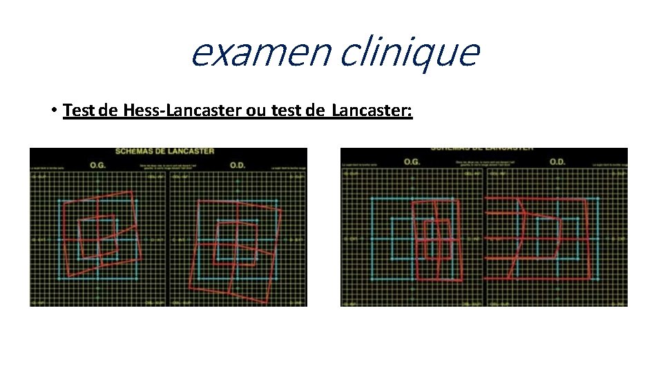 examen clinique • Test de Hess-Lancaster ou test de Lancaster: 