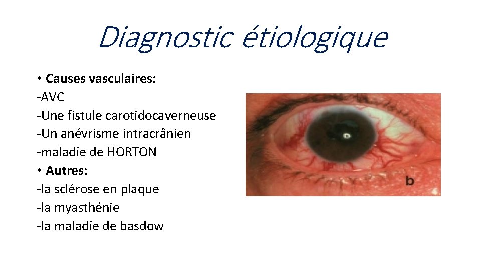 Diagnostic étiologique • Causes vasculaires: -AVC -Une fistule carotidocaverneuse -Un anévrisme intracrânien -maladie de