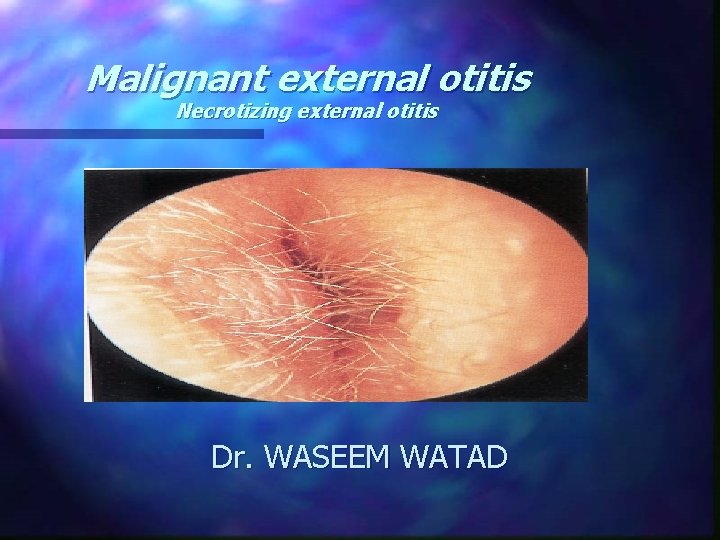 Malignant external otitis Necrotizing external otitis Dr. WASEEM WATAD 