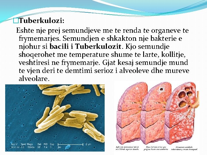 �Tuberkulozi: Eshte nje prej semundjeve me te renda te organeve te frymemarjes. Semundjen e