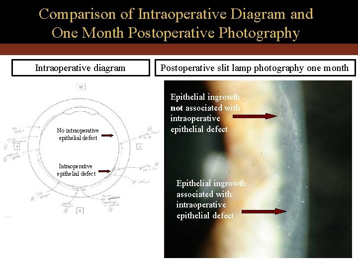 Comparison of Intraoperative Diagram and One Month Postoperative Photography Intraoperative diagram No intraoperative epithelial