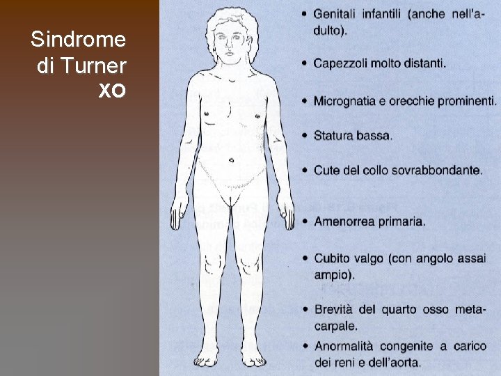 Sindrome di Turner XO 