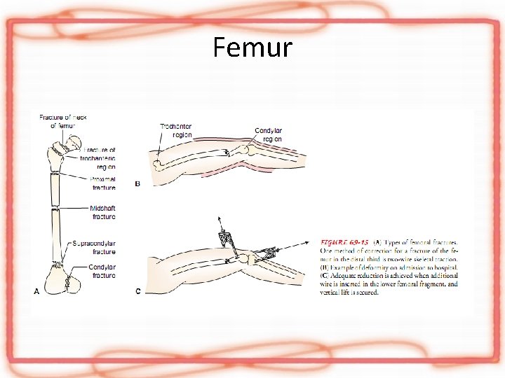Femur 