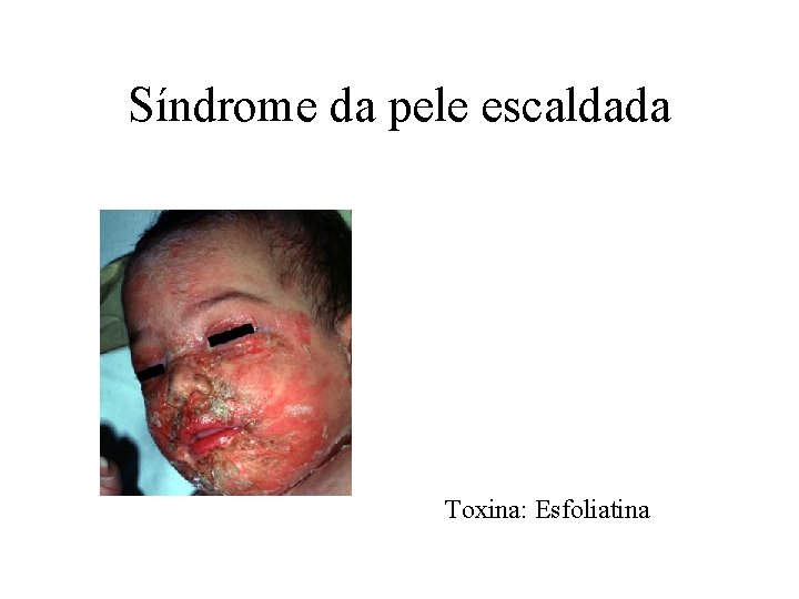 Síndrome da pele escaldada Toxina: Esfoliatina 