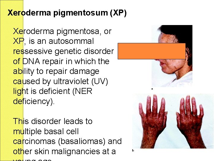 Xeroderma pigmentosum (XP) Xeroderma pigmentosa, or XP, is an autosommal ressessive genetic disorder of