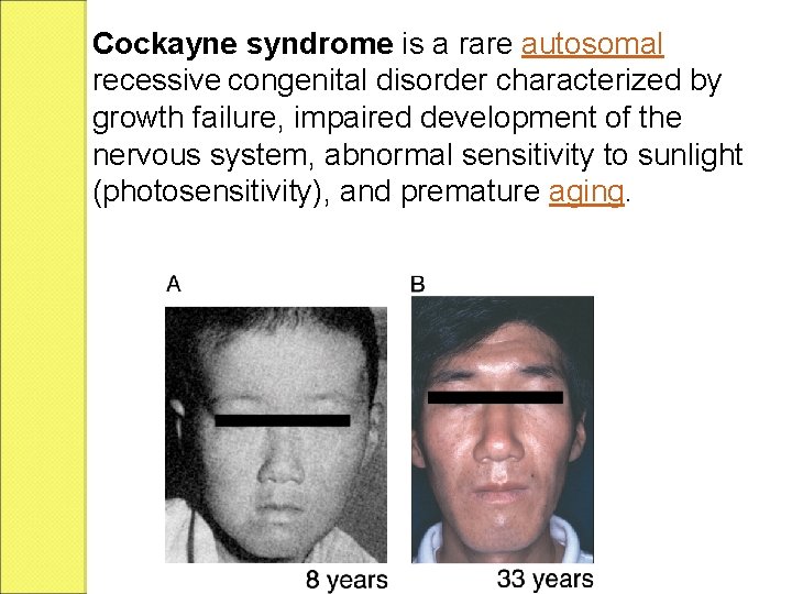 Cockayne syndrome is a rare autosomal recessive congenital disorder characterized by growth failure, impaired