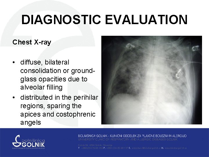 DIAGNOSTIC EVALUATION Chest X-ray • diffuse, bilateral consolidation or groundglass opacities due to alveolar