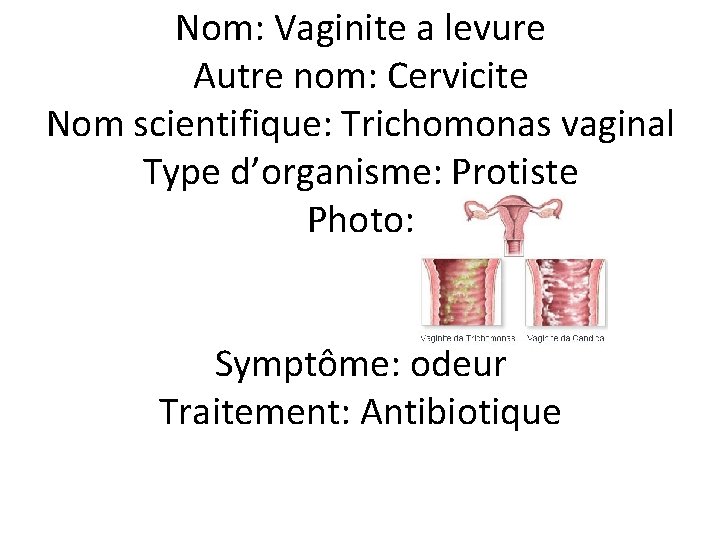 Nom: Vaginite a levure Autre nom: Cervicite Nom scientifique: Trichomonas vaginal Type d’organisme: Protiste