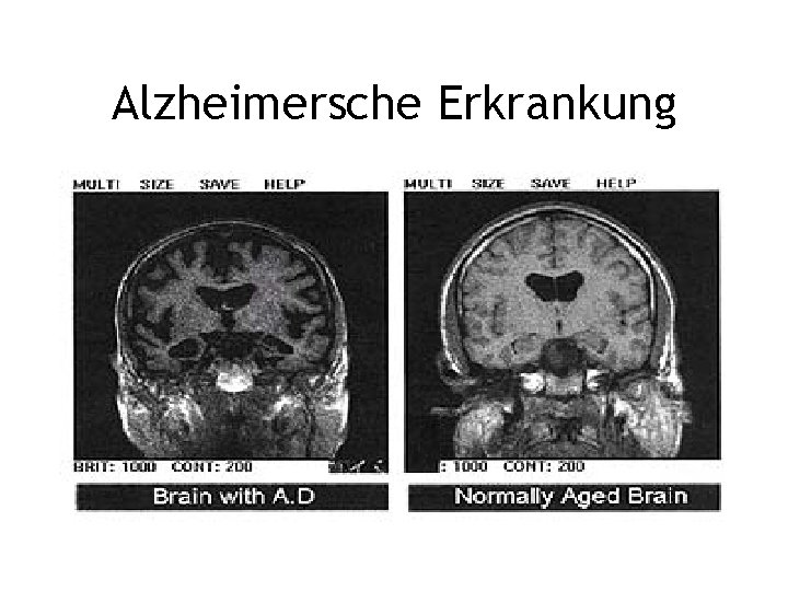 Alzheimersche Erkrankung 