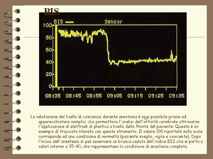 BIS La valutazione del livello di coscienza durante anestesia è oggi possibile grazie ad