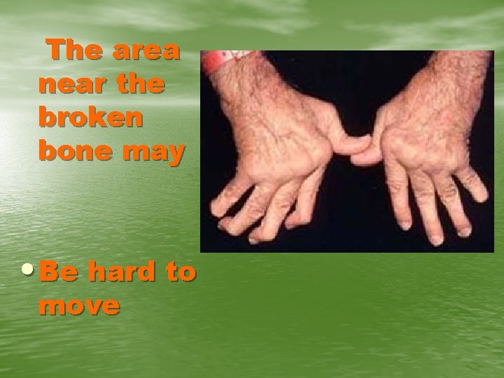 The area near the broken bone may • Be hard to move 