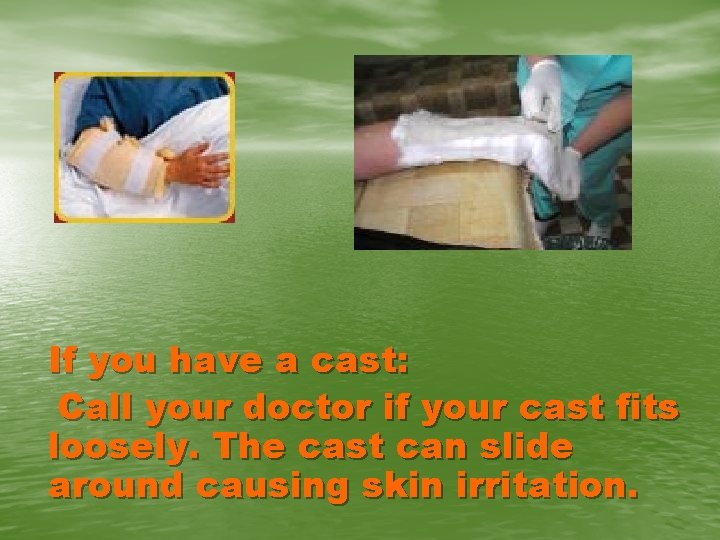 If you have a cast: Call your doctor if your cast fits loosely. The