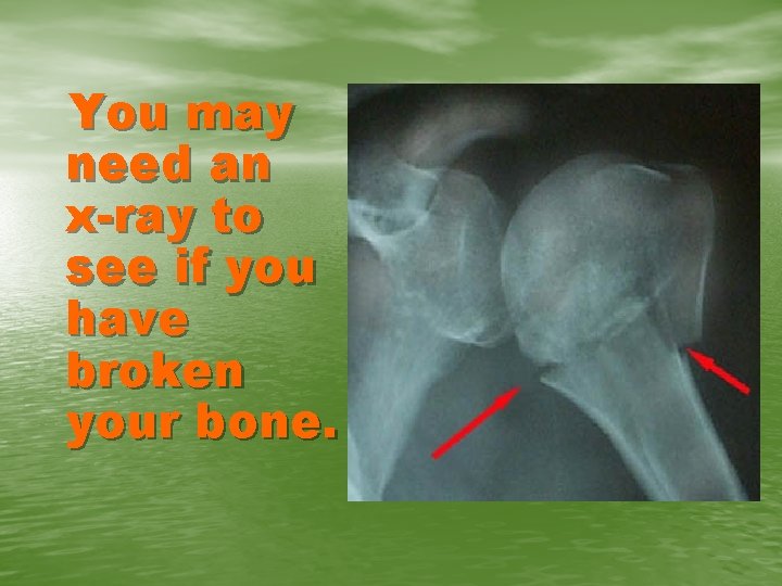 You may need an x-ray to see if you have broken your bone. 