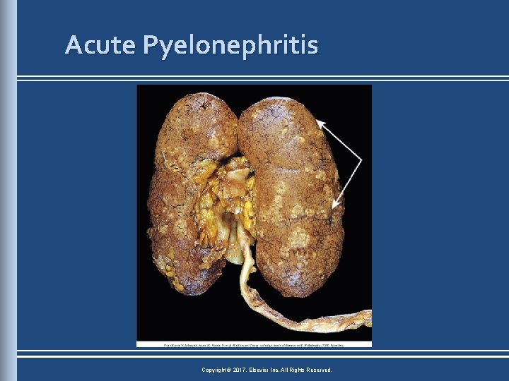 Acute Pyelonephritis Copyright © 2017, Elsevier Inc. All Rights Reserved. 