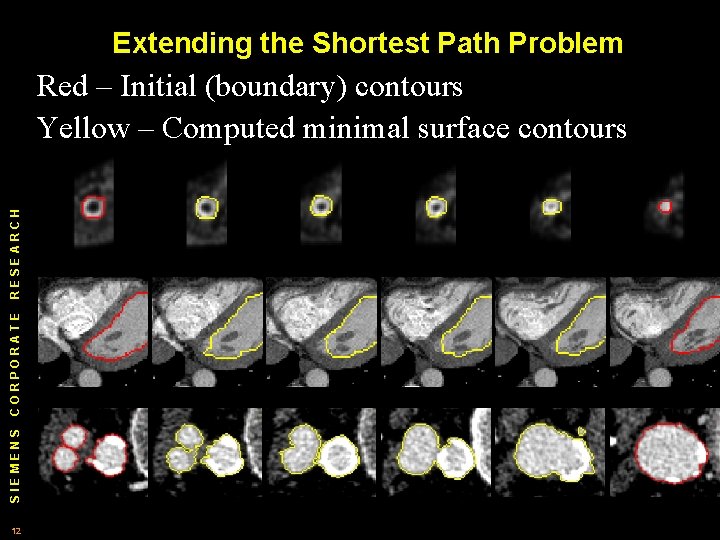 Extending the Shortest Path Problem SIEMENS CORPORATE RESEARCH Red – Initial (boundary) contours Yellow Extending the Shortest Path Problem SIEMENS CORPORATE RESEARCH Red – Initial (boundary) contours Yellow