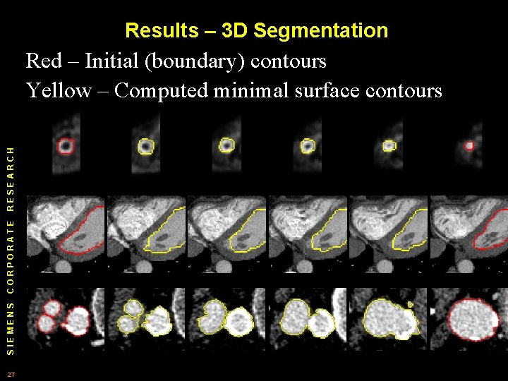 Results – 3 D Segmentation SIEMENS CORPORATE RESEARCH Red – Initial (boundary) contours Yellow Results – 3 D Segmentation SIEMENS CORPORATE RESEARCH Red – Initial (boundary) contours Yellow