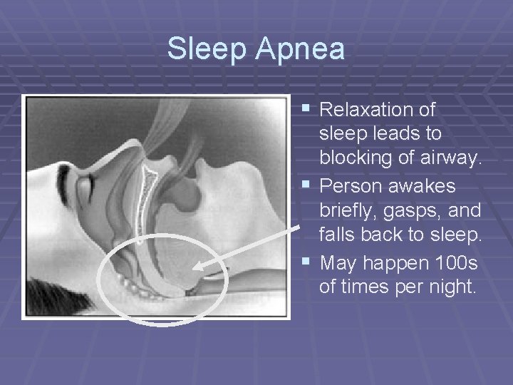 Sleep Apnea § Relaxation of sleep leads to blocking of airway. § Person awakes