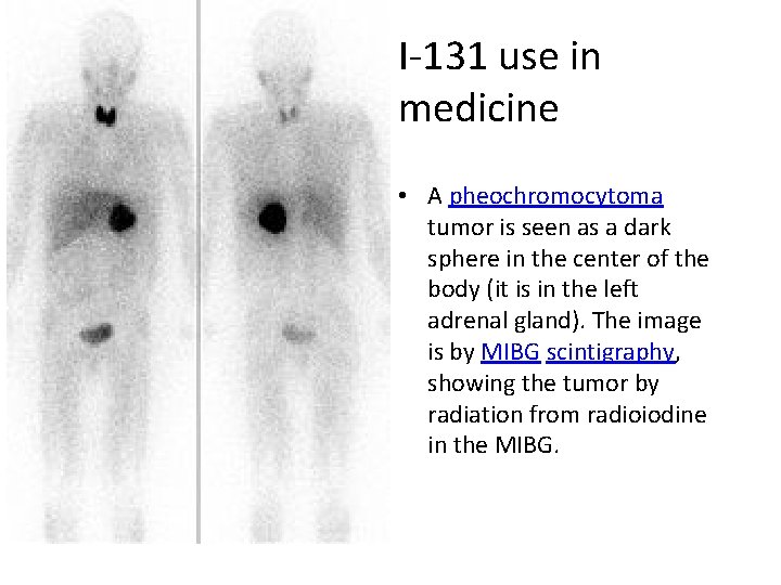 I-131 use in medicine • A pheochromocytoma tumor is seen as a dark sphere