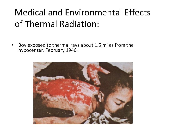 Medical and Environmental Effects of Thermal Radiation: • Boy exposed to thermal rays about
