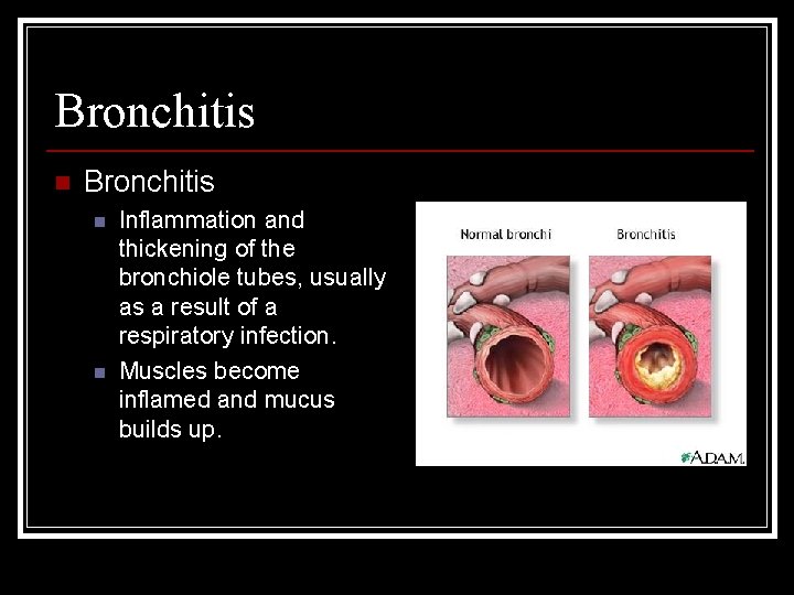 Bronchitis n n Inflammation and thickening of the bronchiole tubes, usually as a result