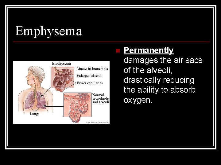 Emphysema n Permanently damages the air sacs of the alveoli, drastically reducing the ability