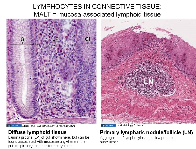 LYMPHOCYTES IN CONNECTIVE TISSUE: MALT = mucosa-associated lymphoid tissue LN �Ross and Pawlina ,