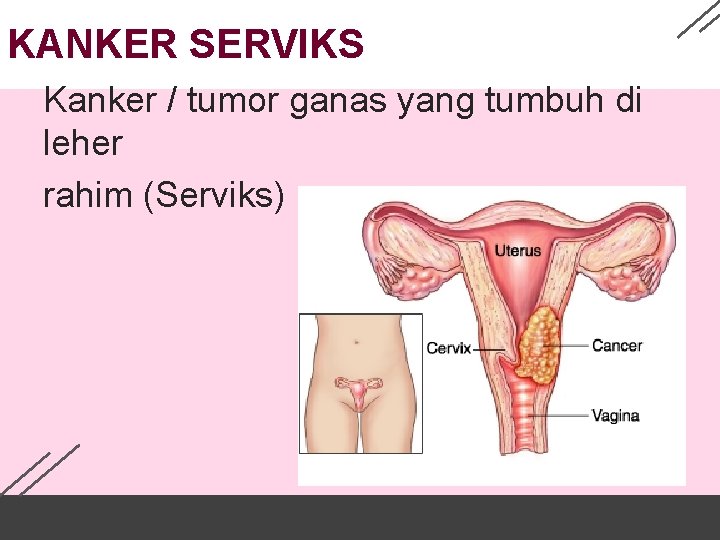 KANKER SERVIKS Kanker / tumor ganas yang tumbuh di leher rahim (Serviks) 
