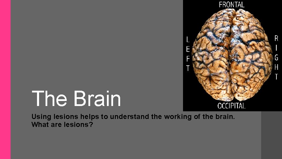 The Brain Using lesions helps to understand the working of the brain. What are