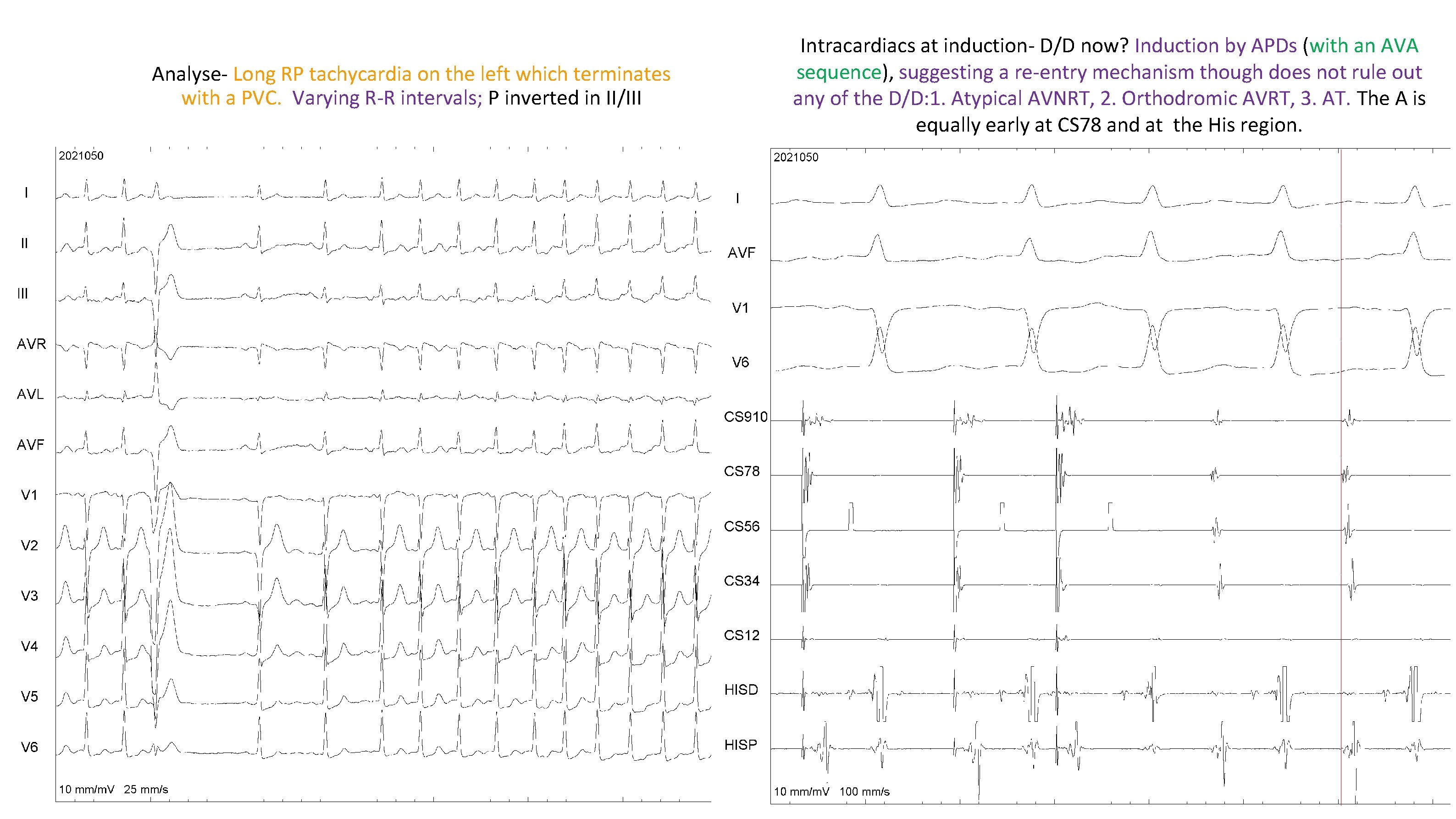 Analyse- Long RP tachycardia on the left which terminates with a PVC. Varying R-R Analyse- Long RP tachycardia on the left which terminates with a PVC. Varying R-R