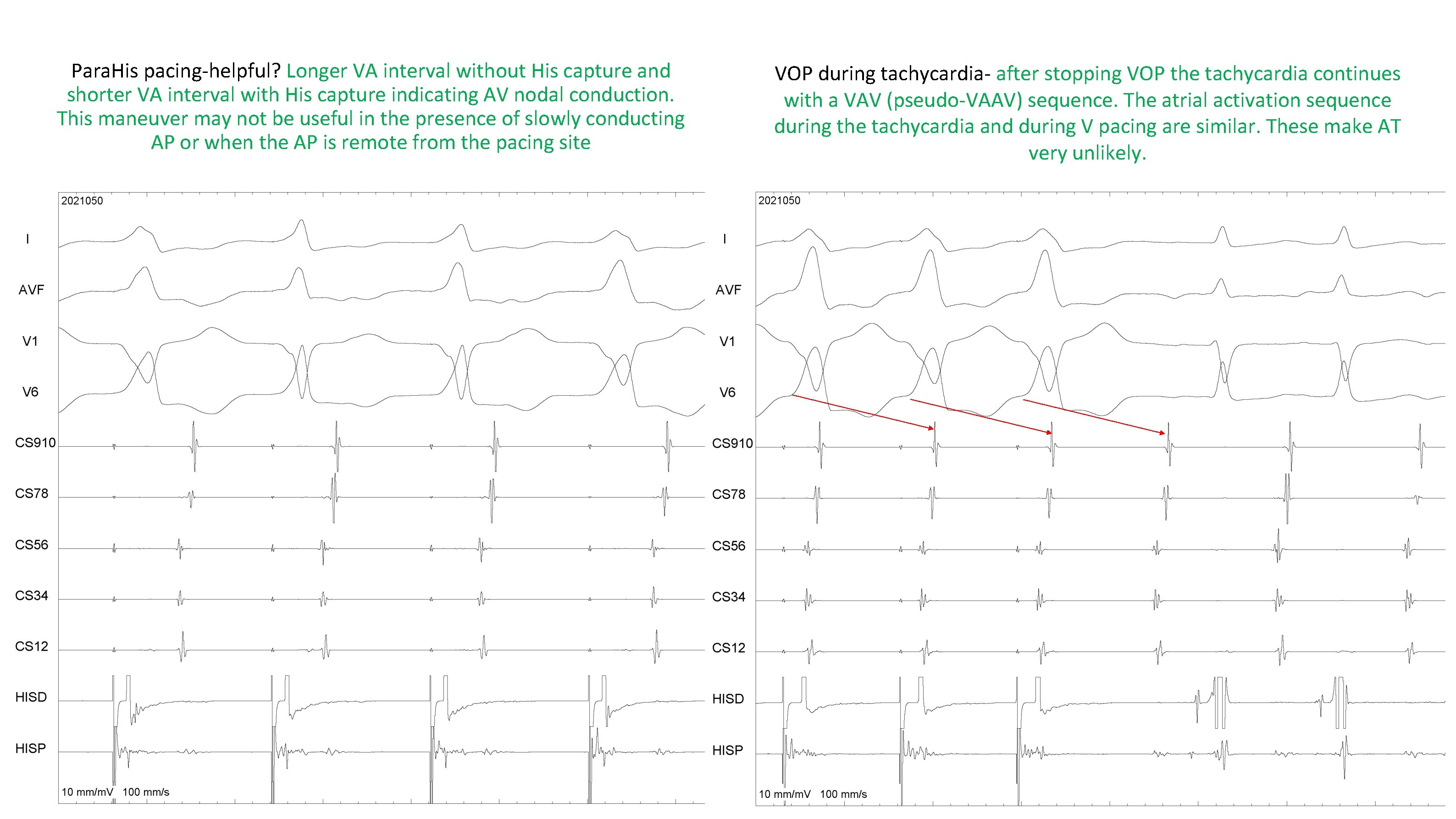 Para. His pacing-helpful? Longer VA interval without His capture and shorter VA interval with Para. His pacing-helpful? Longer VA interval without His capture and shorter VA interval with
