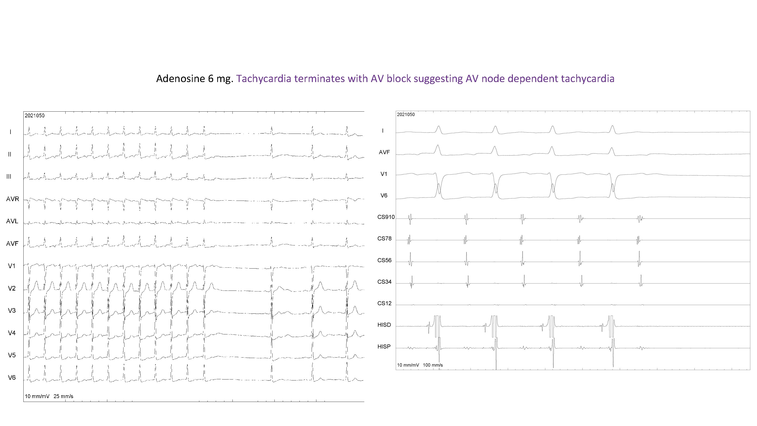 Adenosine 6 mg. Tachycardia terminates with AV block suggesting AV node dependent tachycardia Adenosine 6 mg. Tachycardia terminates with AV block suggesting AV node dependent tachycardia