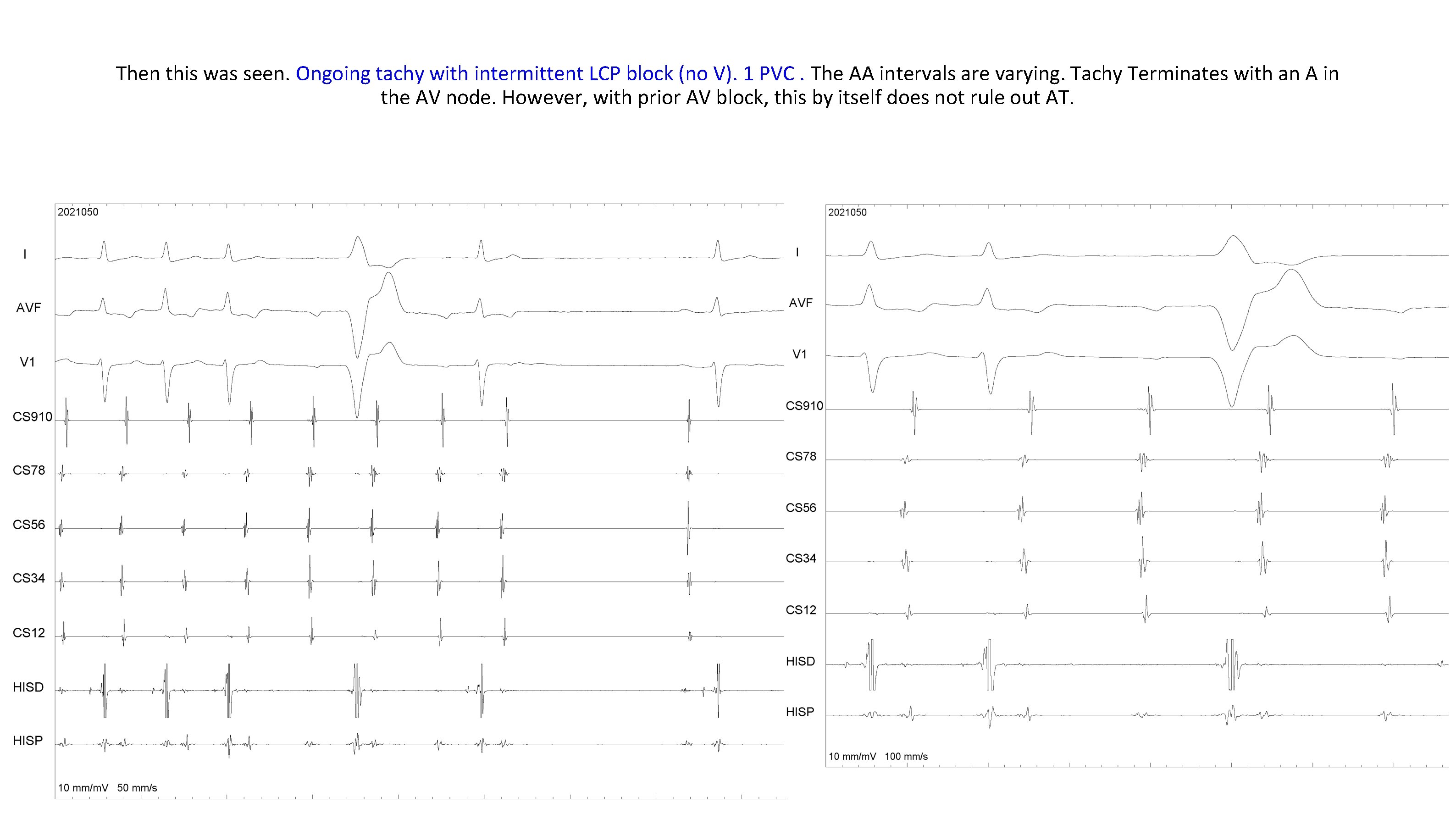 Then this was seen. Ongoing tachy with intermittent LCP block (no V). 1 PVC. Then this was seen. Ongoing tachy with intermittent LCP block (no V). 1 PVC.