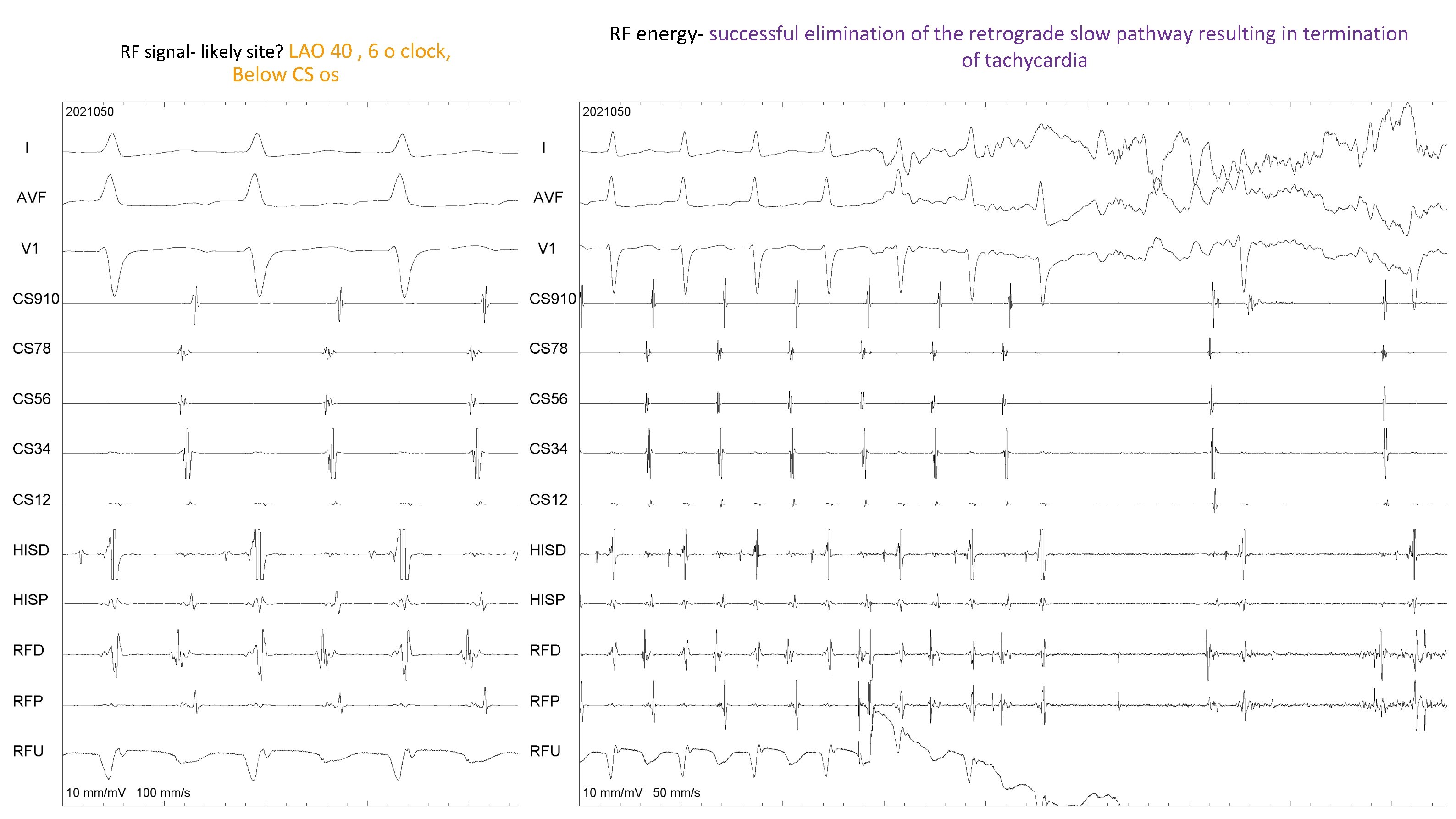 RF signal- likely site? LAO 40 , 6 o clock, Below CS os RF RF signal- likely site? LAO 40 , 6 o clock, Below CS os RF