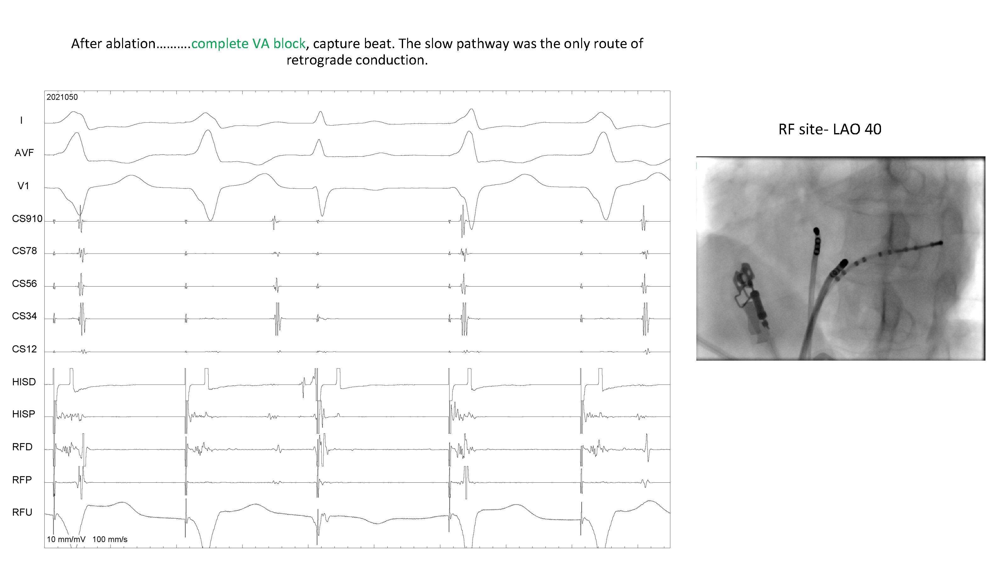 After ablation………. complete VA block, capture beat. The slow pathway was the only route After ablation………. complete VA block, capture beat. The slow pathway was the only route