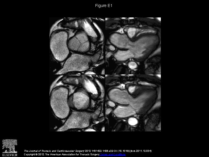 Figure E 1 The Journal of Thoracic and Cardiovascular Surgery 2012 1431422 -1428. e