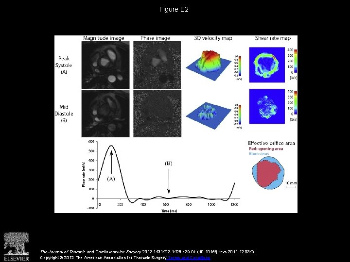 Figure E 2 The Journal of Thoracic and Cardiovascular Surgery 2012 1431422 -1428. e